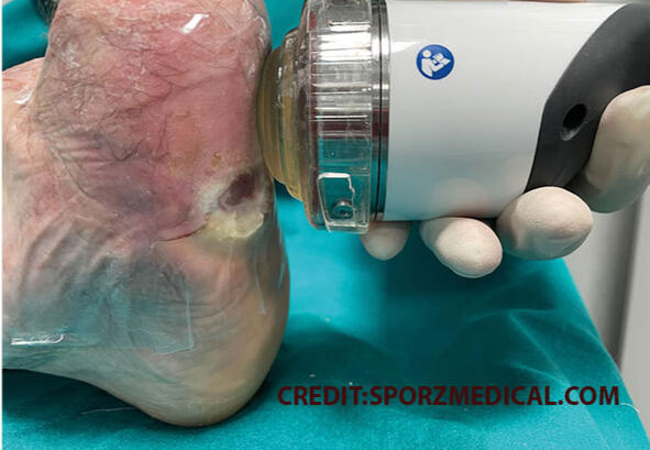 Why Choose Shockwave EPAT Theraphy